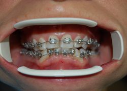 Aparat ortodontyczny stały