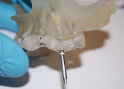 Implanty za pomocą własnego patentu
