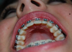 Leczenie ortodontyczne aparatem stałym