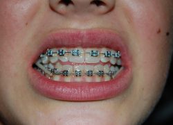 Leczenie ortodontyczne aparatem stałym