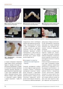 Selected Aspects of Manufacturing of Medical Models for Implantoprosthetic Applications strona 3